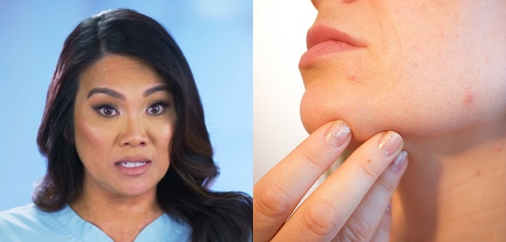 En tan sólo 4 pasos: doctora Sandra Lee entregó las claves para tratar el acné en casa