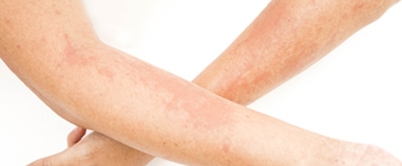 Celulitis, la infección que podría volverse grave si no la tratas a tiempo: conoce sus causas