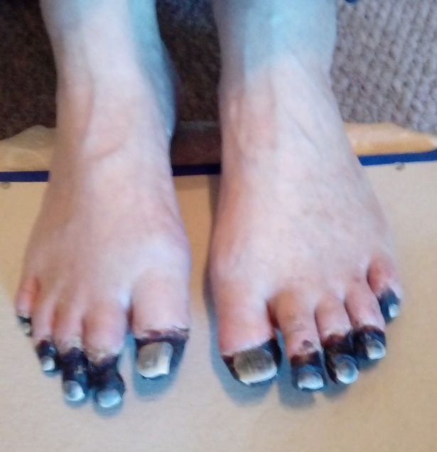 dedos negros Simon Charlesworth