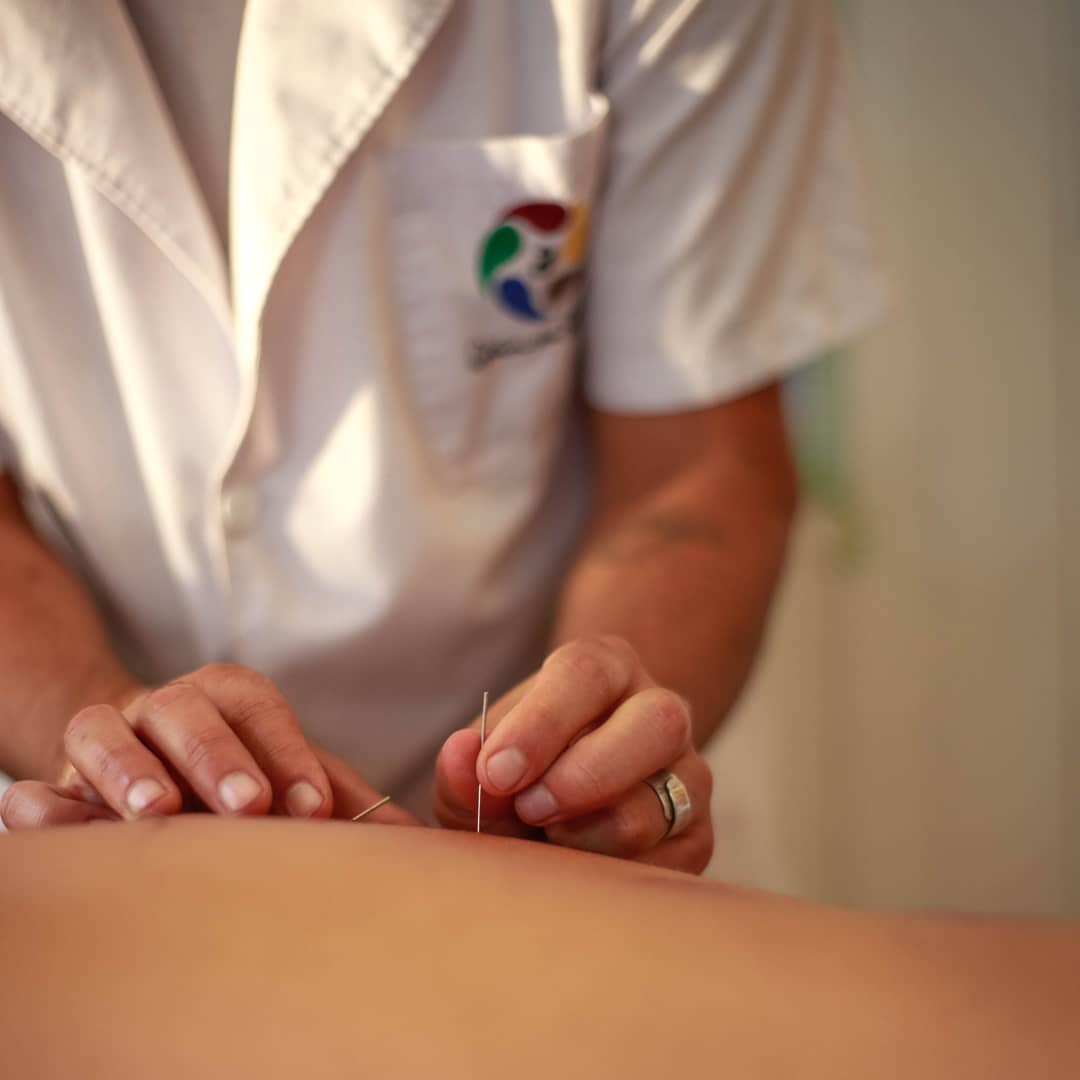 acupuntura