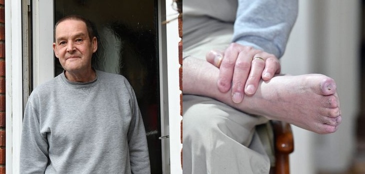 El calvario que vive británico a raíz de una neumonía: sus dedos de los pies se cayeron uno por uno