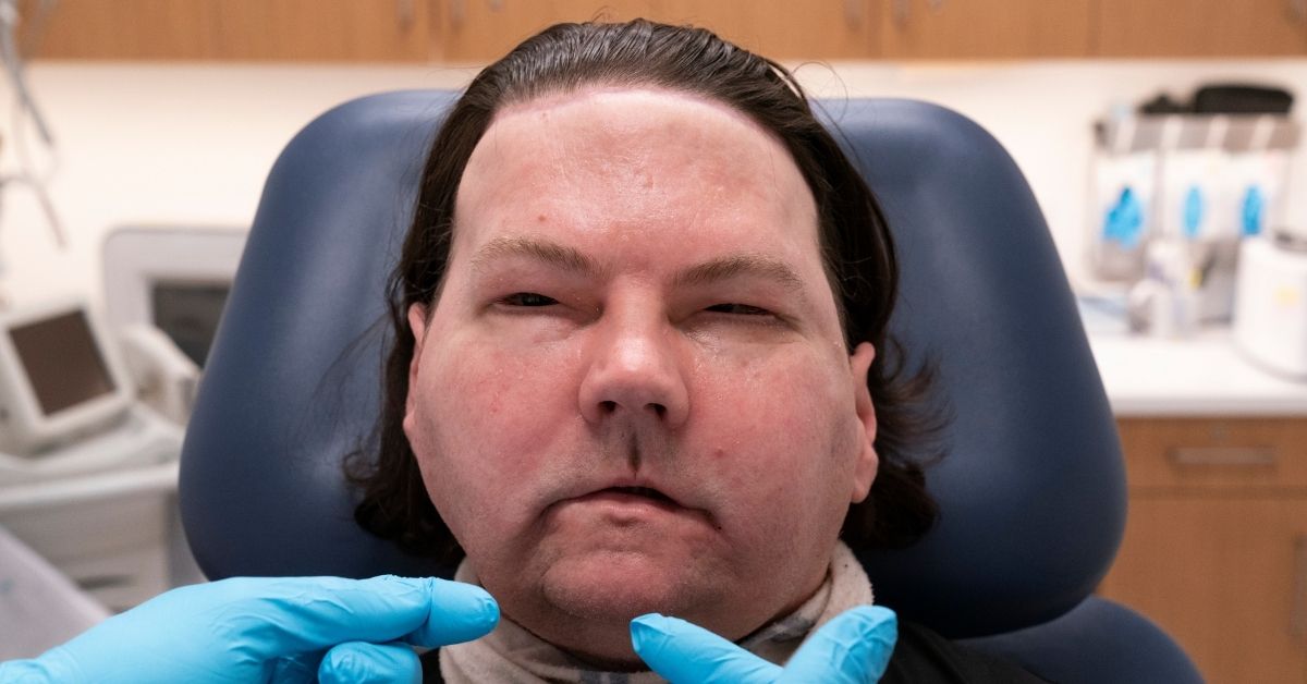 Víctima de accidente automovilístico recibe primer trasplante de cara y manos en EEUU