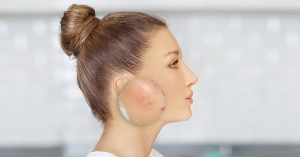 Los beneficios de los probióticos para combatir la rosácea y el acné