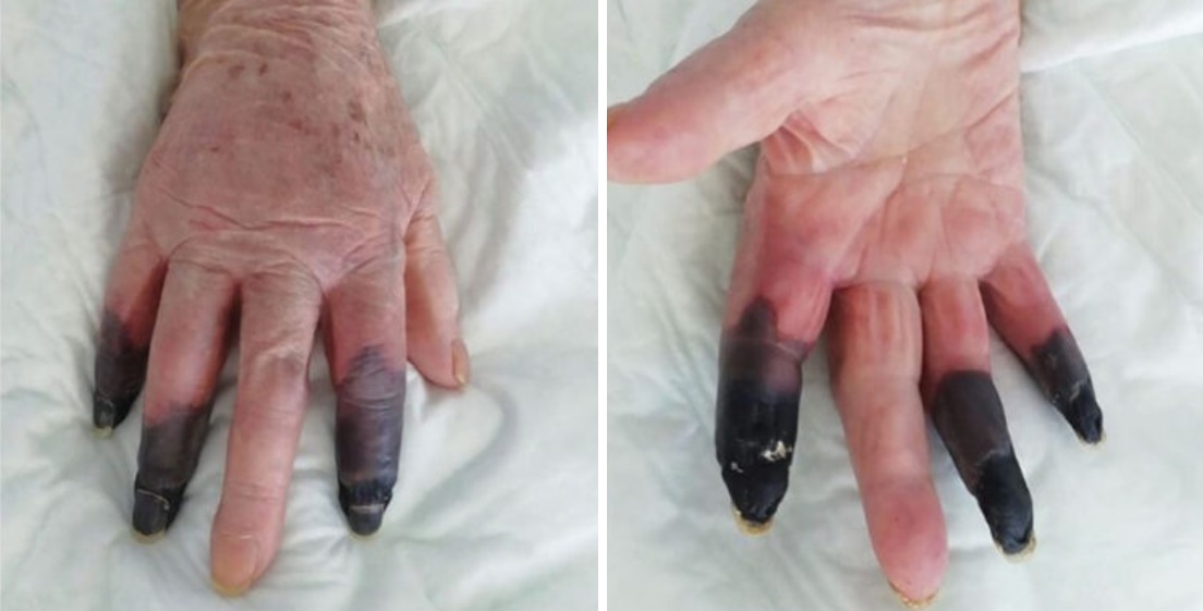 Mujer desarrolló gangrena tras infección por COVID-19: tuvieron que amputarle 3 dedos de una mano