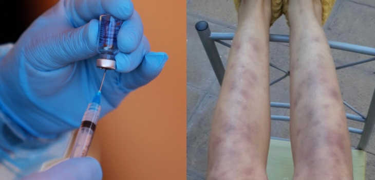 Profesora porteña vacunada contra el COVID-19 sufrió graves complicaciones: 