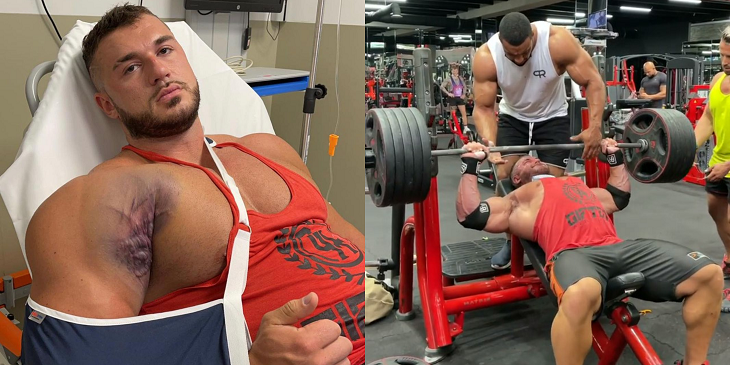 “Me arranqué completamente el tendón pectoral del hueso”: fisicoculturista sufrió impactante lesión