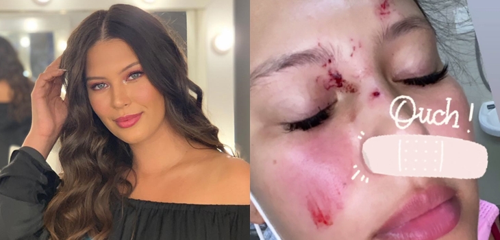 Michelle Carvalho sufrió accidente automovilístico en Brasil: mostró imágenes de sus lesiones