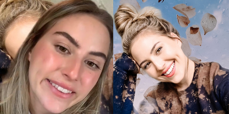 Joven viralizó cómo bótox arruinó su sonrisa: 