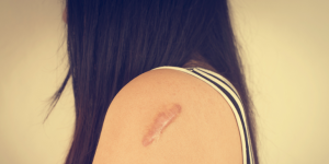 Investigación busca crear fármaco que ayuda a la curación de heridas sin dejar cicatrices