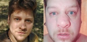 Ex 'Yingo' Ariel Osses sufrió rara inflamación en su nariz: especialistas aún no determinan qué pasó