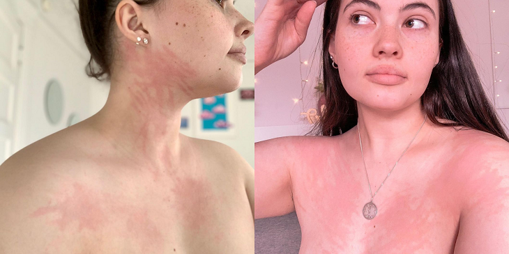 El drama de joven que es alérgica al agua: sufre irritaciones con sus lágrimas, al beber y ducharse