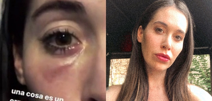 Celulitis periorbitaria: la infección que afectó a Vale Roth y que preocupó a seguidores