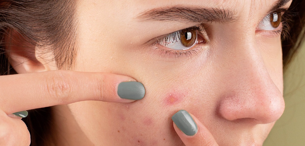 De perejil hasta una pasta de aspirina: los 5 secretos de facialistas para disimular las espinillas