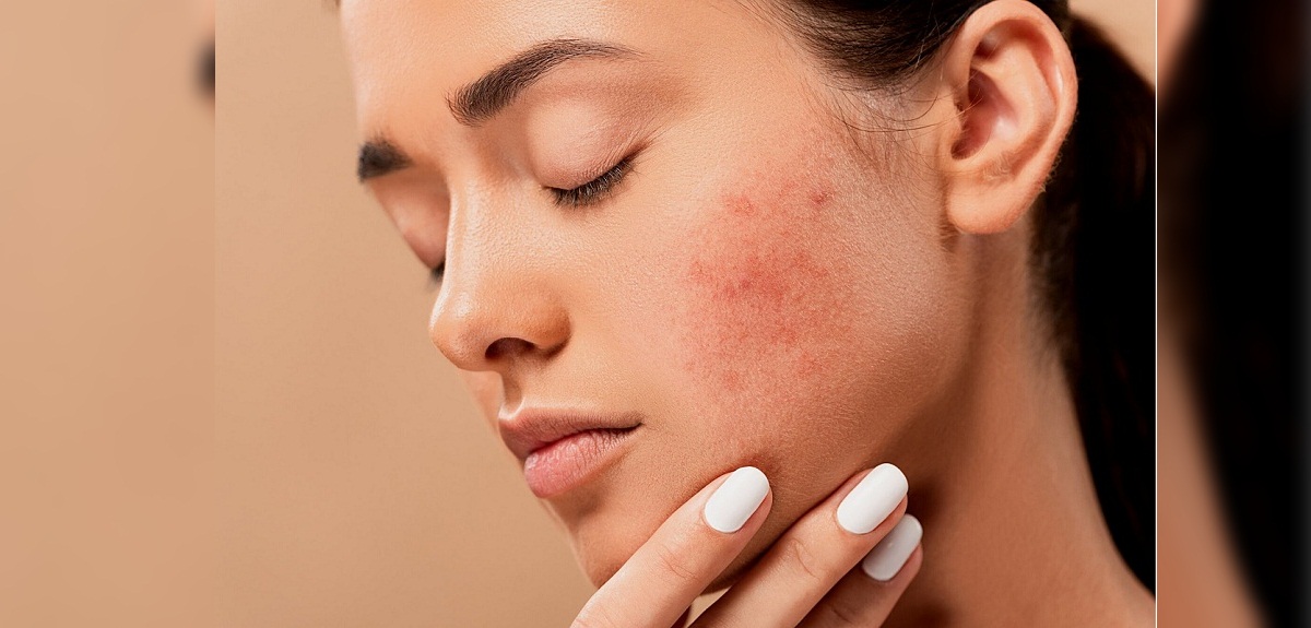 Dermatólogo explica qué hacer (y no hacer por ningún motivo) con las molestas 'espinillas ciegas'