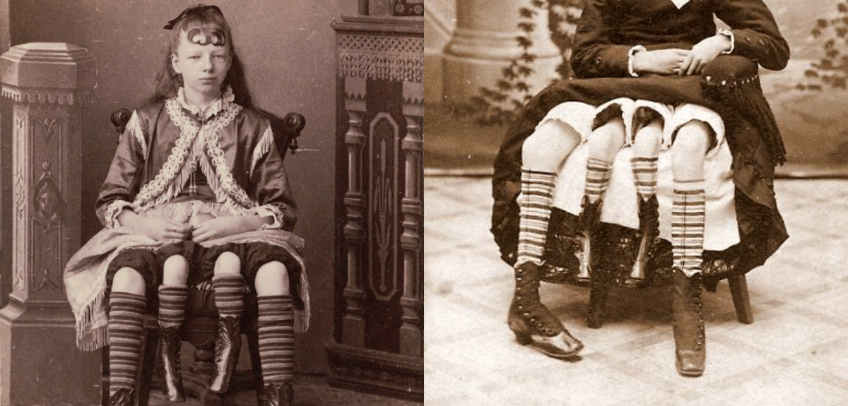 La increíble historia de Josephine Myrtle Corbin, la mujer estadounidense de 4 piernas y 2 pelvis