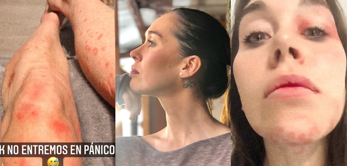 Valentina Roth asistió a la clínica tras presentar urticaria en todo su cuerpo: 