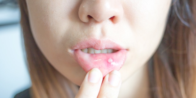 Aftas | Clínica Las Condes