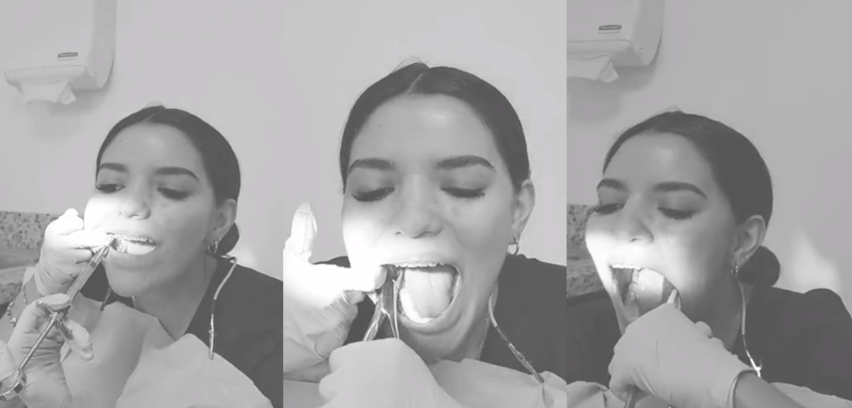 Aterradoramente genial: dentista se hace viral por grabarse sacándose las muelas del juicio