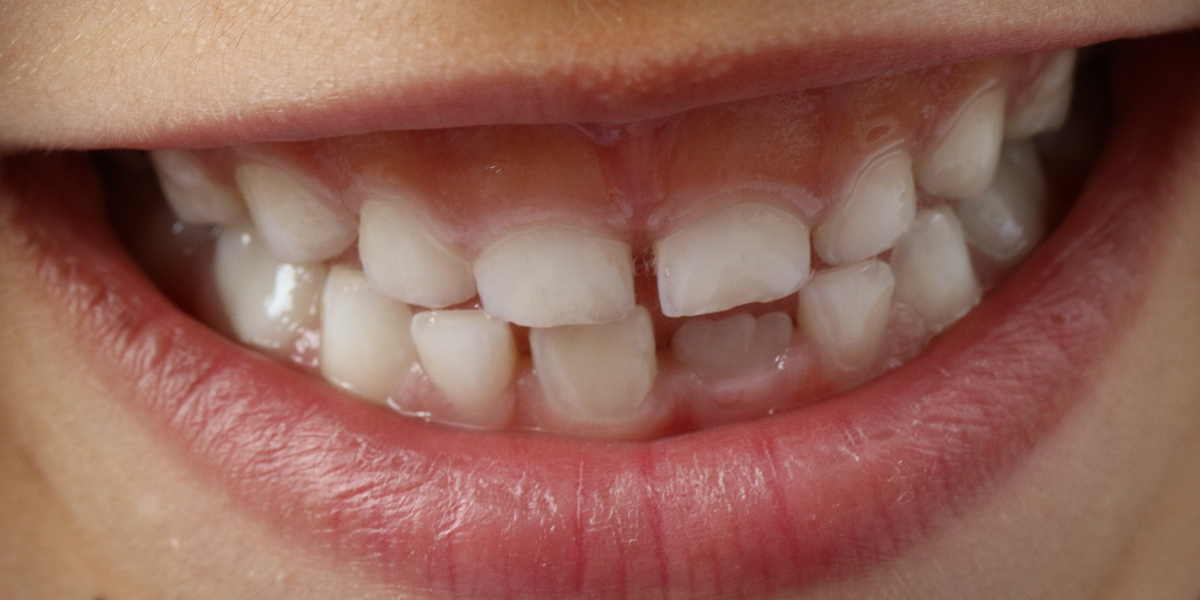 Dientes en mal estado pueden producir graves enfermedades tales como demencia y ataques cardíacos