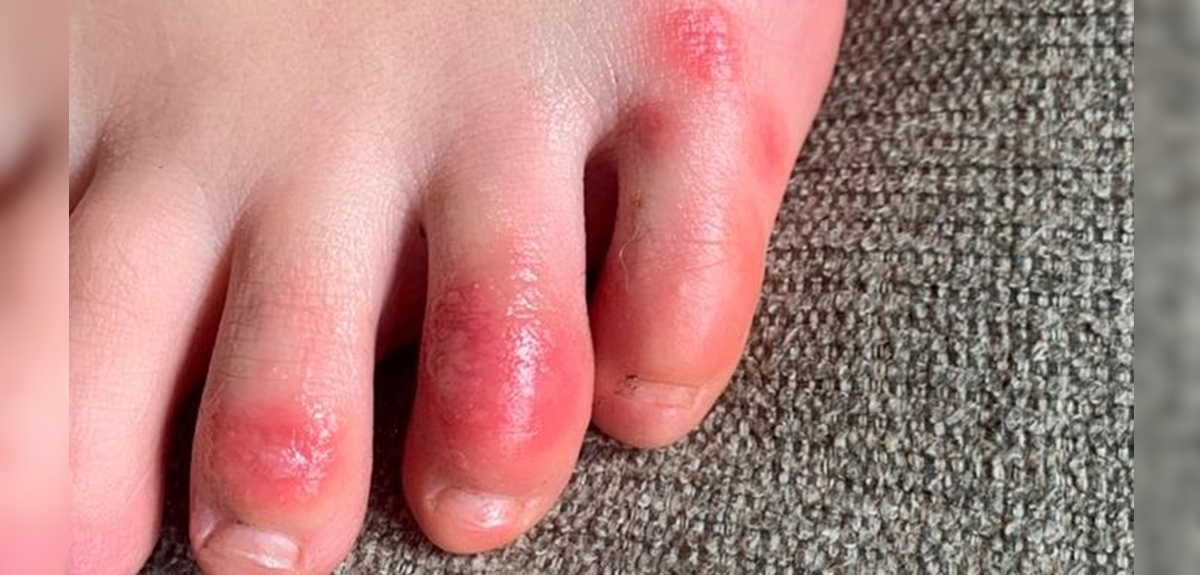 'Dedos COVID': signo sería un efecto secundario de la lucha del organismo contra el virus