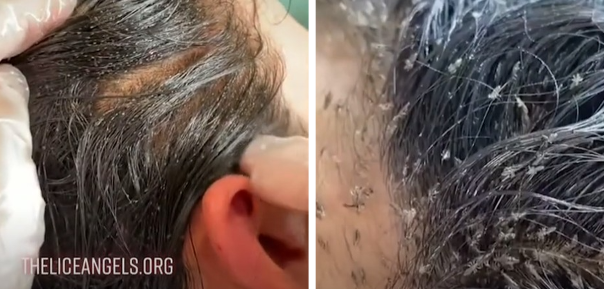 Viralizan video de niña con más de 15 mil piojos: buscan advertir riesgos de no tratarlos a tiempo