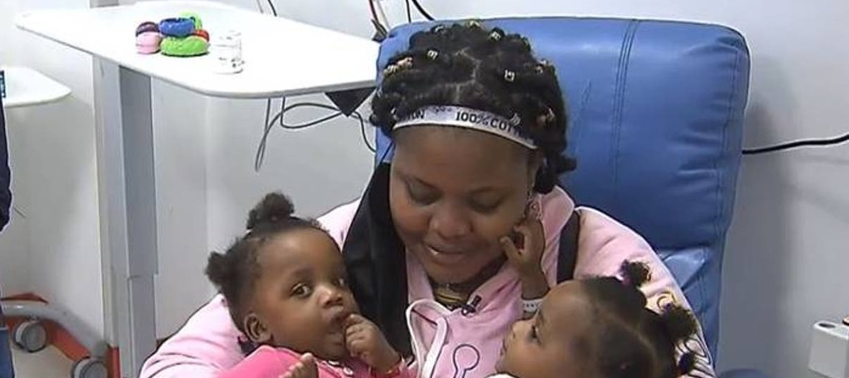 Hazaña médica: 64 profesionales separaron a siamesas Diana y Diaveline tras 16 horas de cirugía