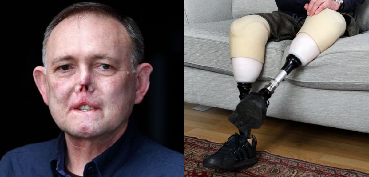 Su perro lo arañó y lamió la herida: 4 meses después perdió las piernas, dedos y parte de la cara