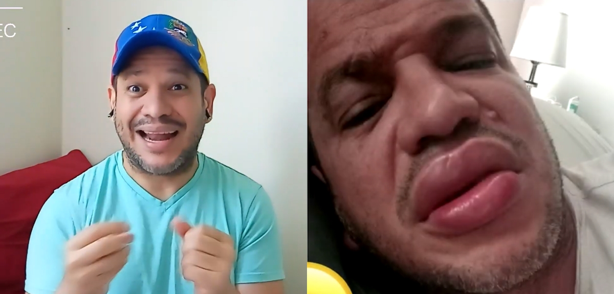 Actor de Pobre Novio reveló que tuvo alarmante reacción alérgica en su rostro: 