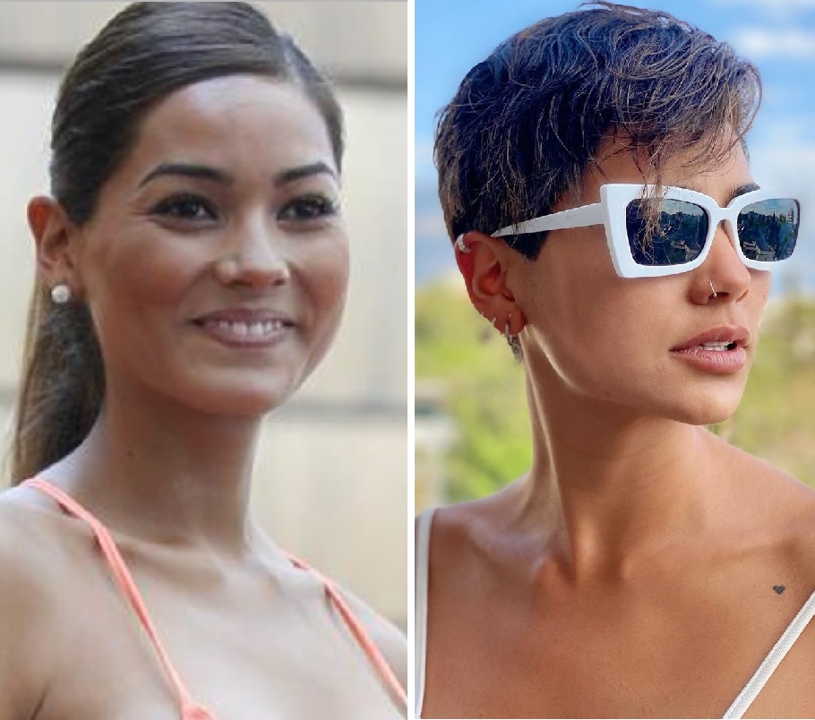 bichectomía Camila Recabarren