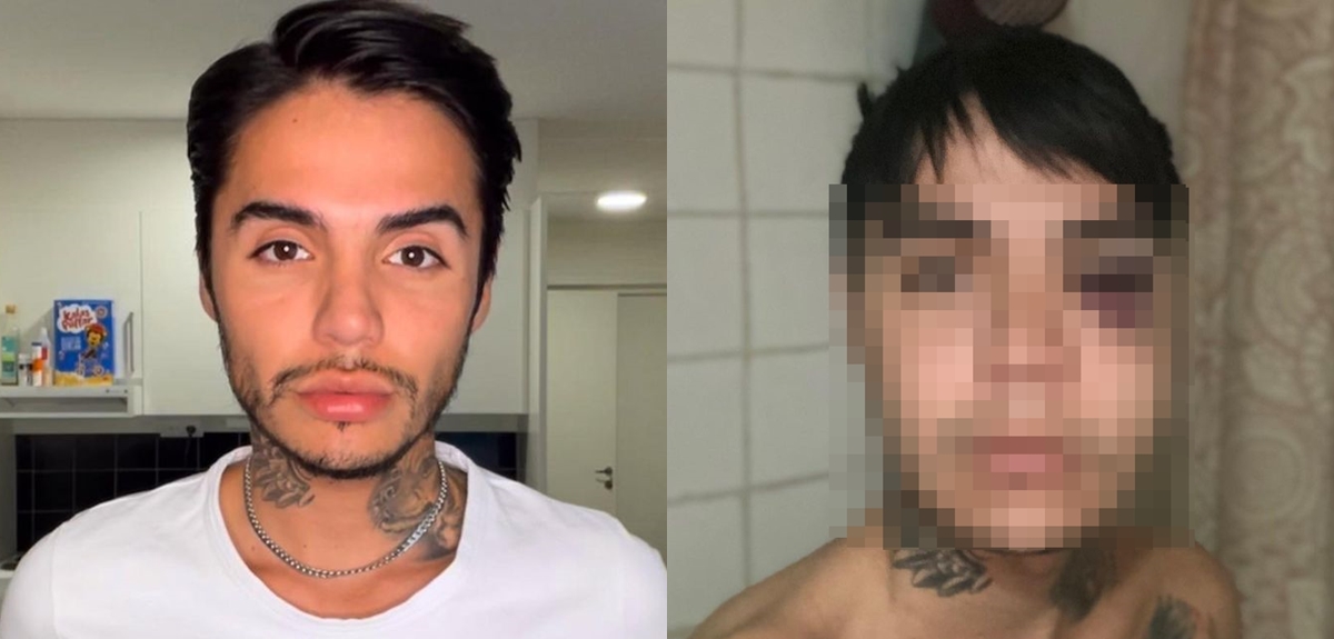 Leo Méndez reveló alarmante motivo de sus heridas y realizó funa: puso como evidencia fotos gráficas