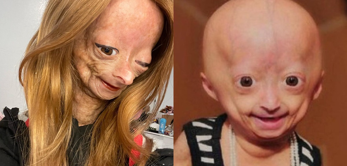 Muere Adalia Rose Williams, youtuber que padecía enfermedad que inspiró película de Benjamin Button