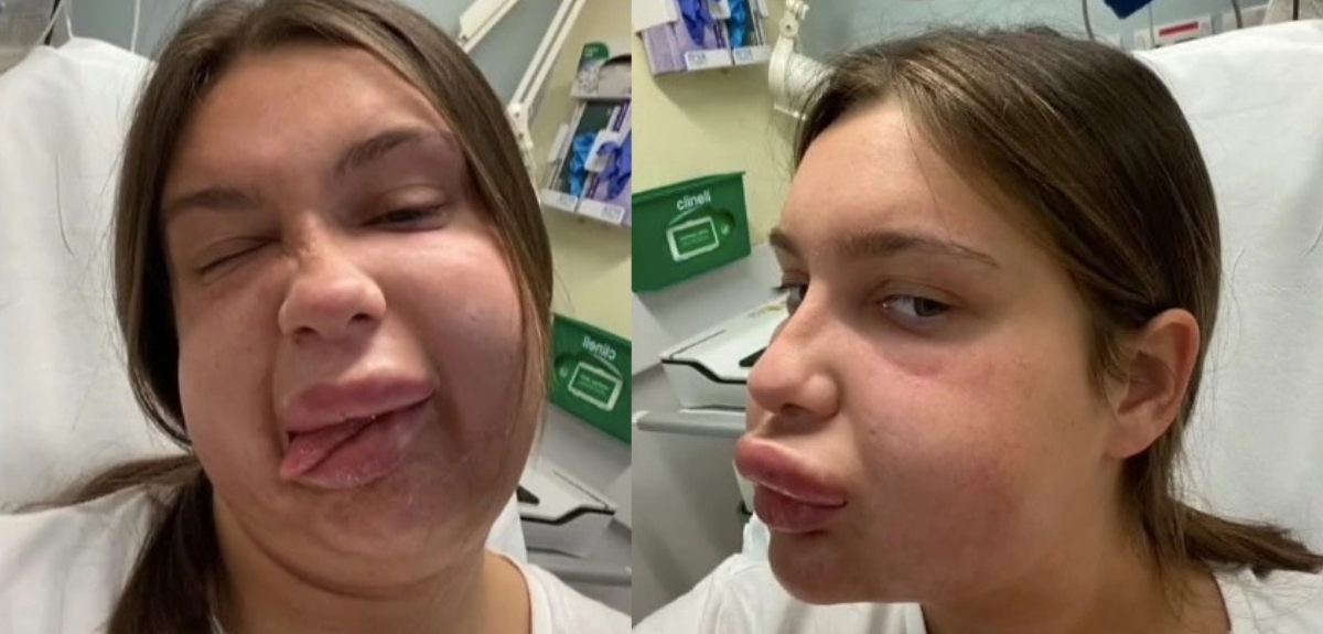 Tiktoker terminó en el hospital por disolver su relleno de labios: la compararon con Homero Simpson