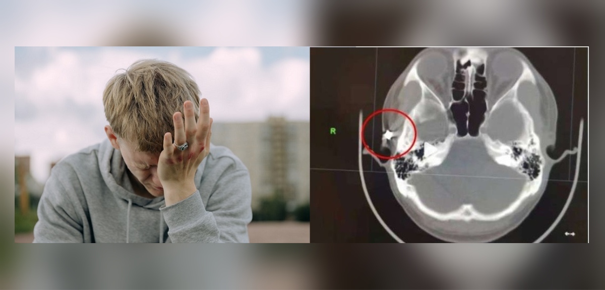 Joven chino sufrió dolores de cabeza por 20 años: resonancia arrojó impactante hallazgo