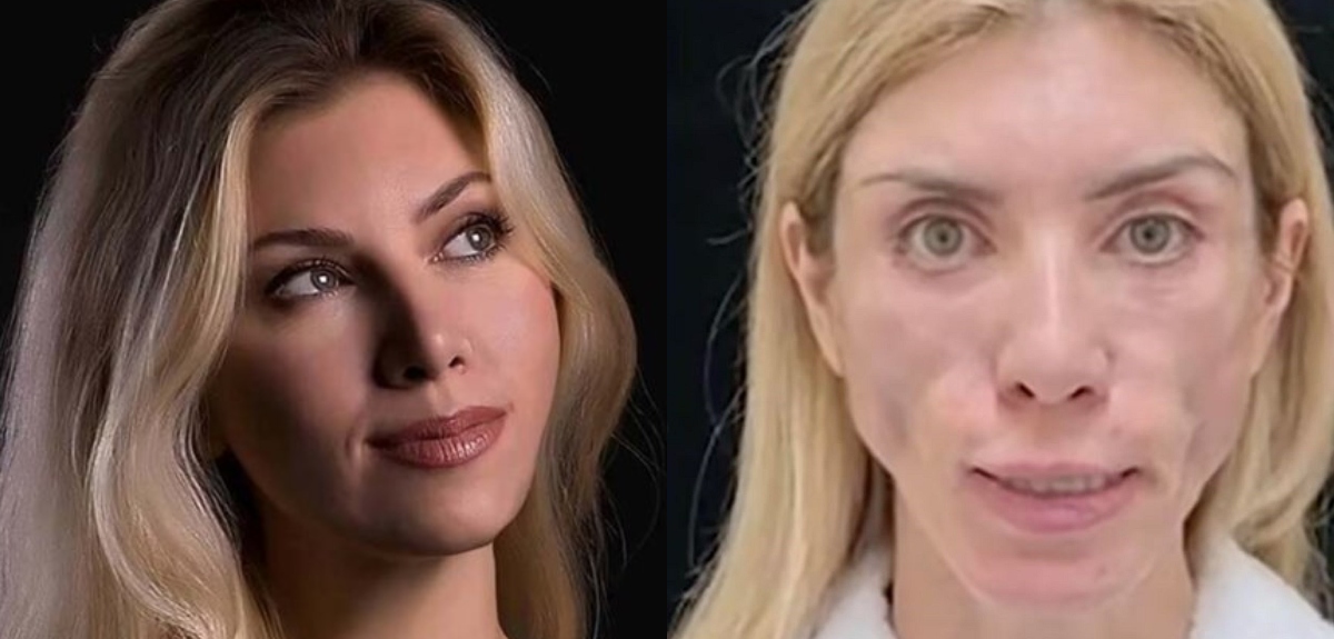 No puede cerrar los ojos ni sonreír: modelo terminó con el rostro desfigurado tras fallida cirugía