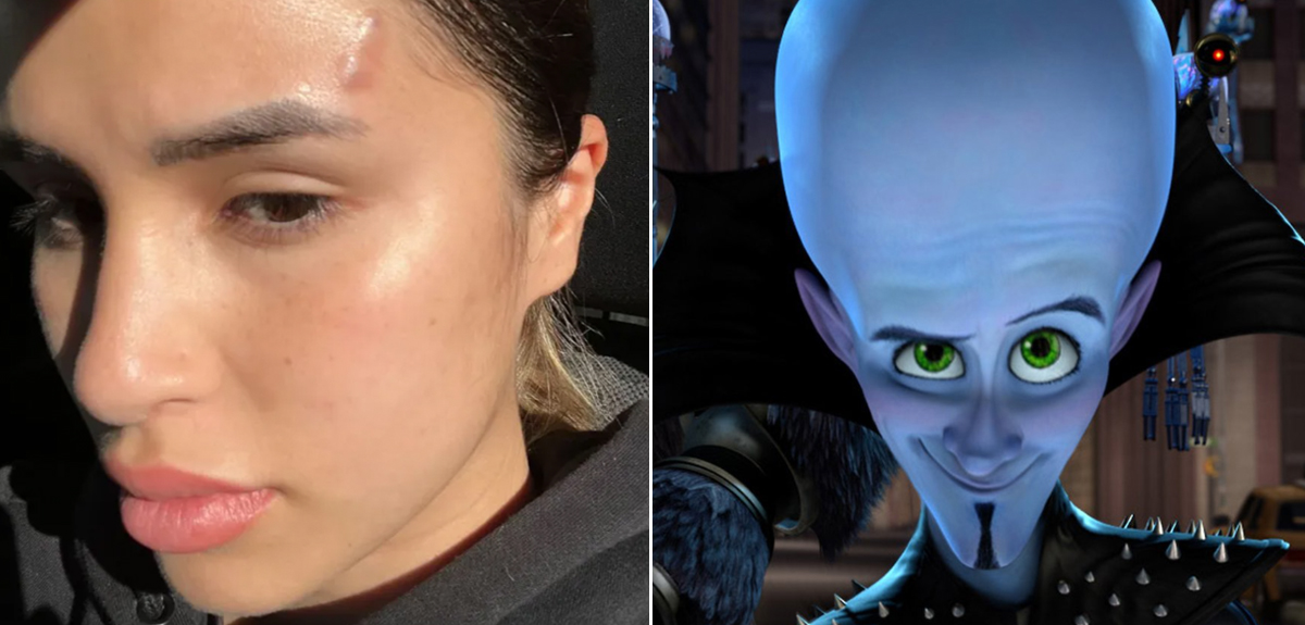 Modelo intentó revertir procedimiento estético fallido y terminó peor: se comparó con 