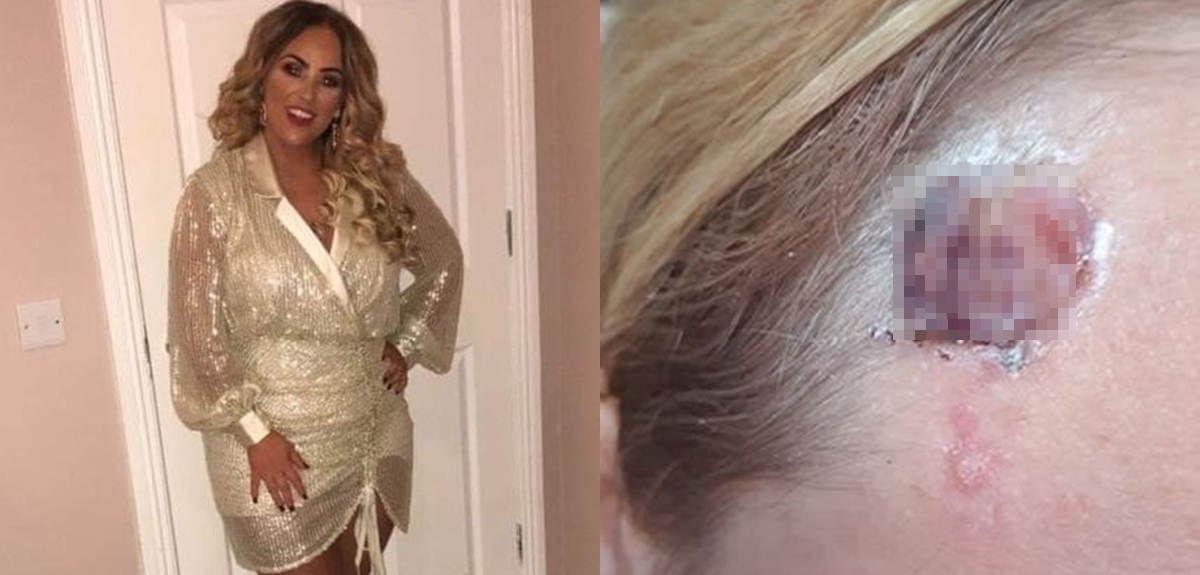 Adicta al solárium descubrió que tenía protuberancia cancerígena cuando iba camino a broncearse