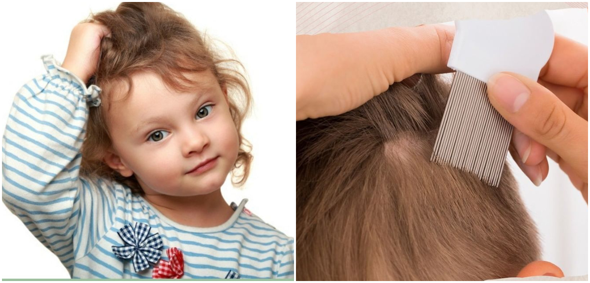 Vuelta a clases presenciales: lo que debes hacer para prevenir la aparición de piojos en los niños