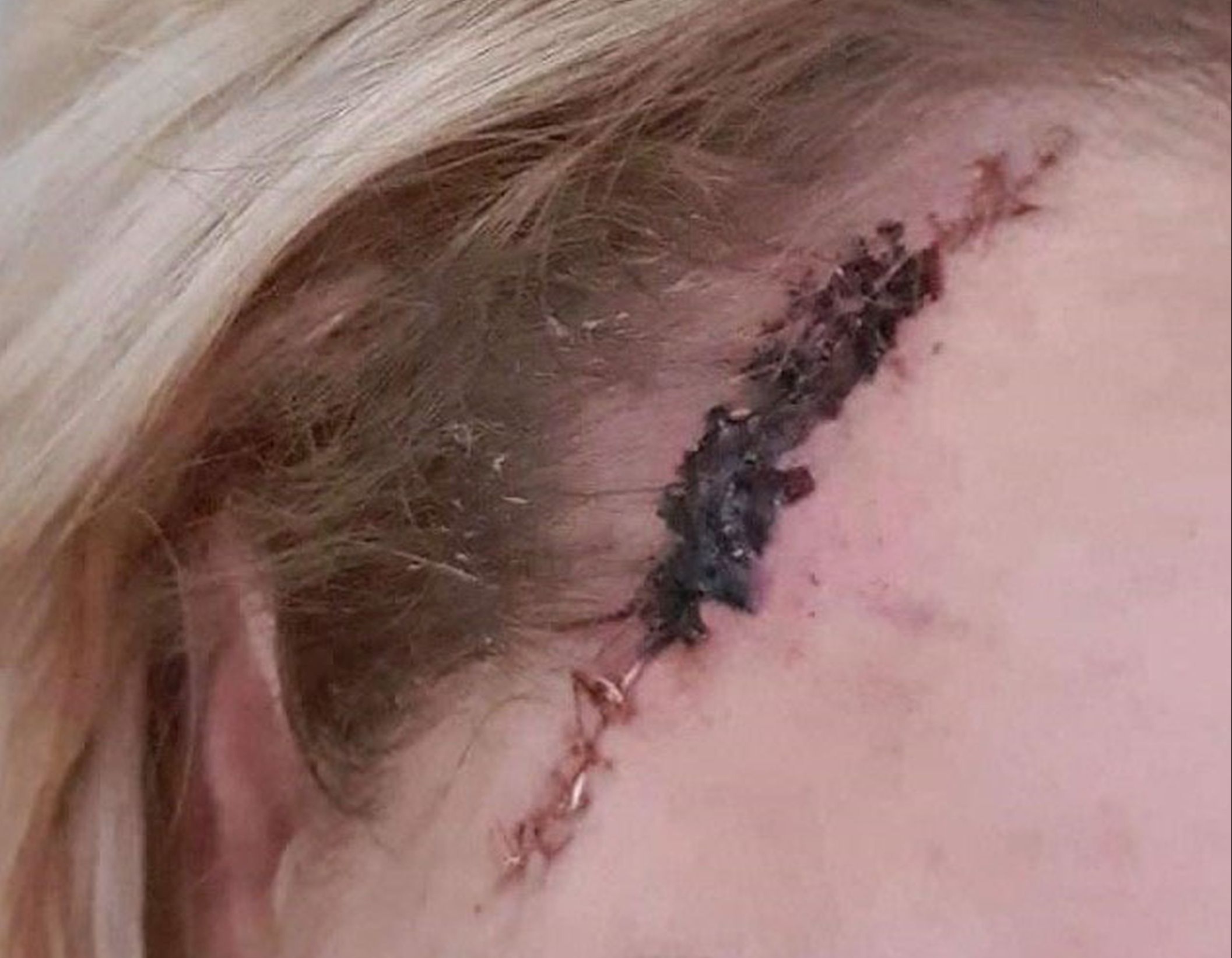 Adicta al solárium descubrió que tenía protuberancia cancerígena cuando iba camino a broncearse