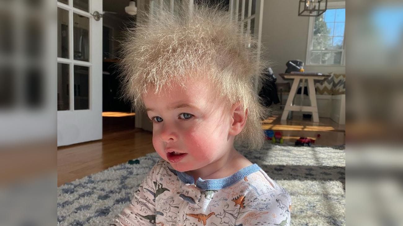 Lock Samples, el niño 'influencer' que fue diagnosticado con el raro síndrome del cabello impeinable