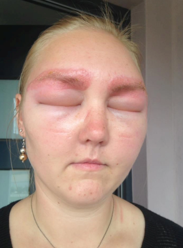 Joven australiana sufrió reacción alérgica.