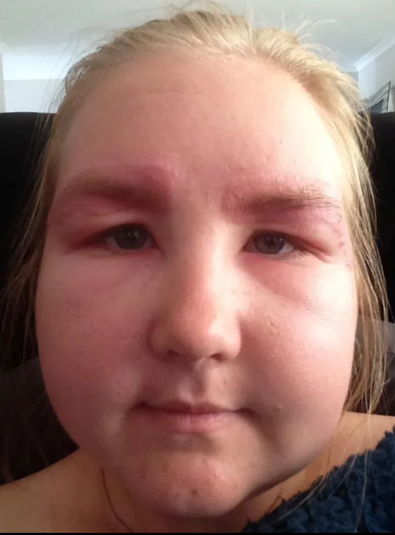 Joven australiana sufrió reacción alérgica.