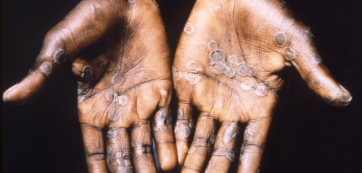 Confirman primer caso de viruela del mono en Argentina: analizan un posible segundo contagiado