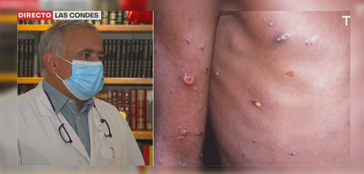 ¿Qué es la viruela del mono? Doctor Ugarte reveló cuáles son sus principales síntomas