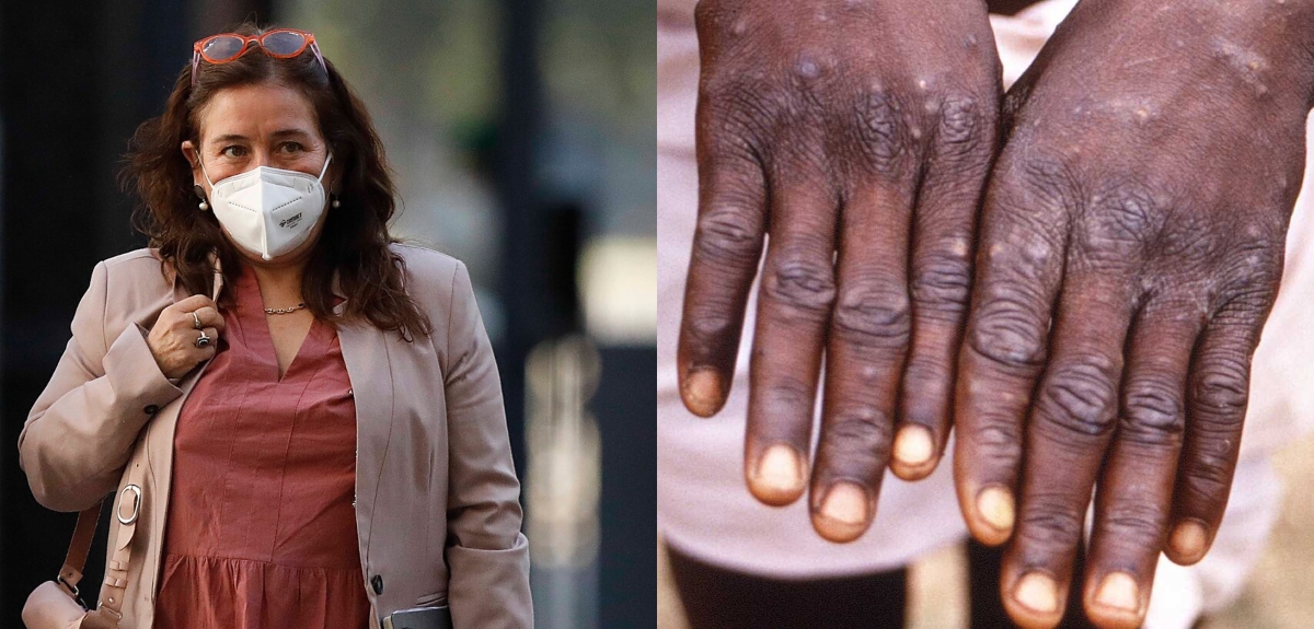 Ministra de Salud aseguró que están monitoreando avance de viruela del mono: 