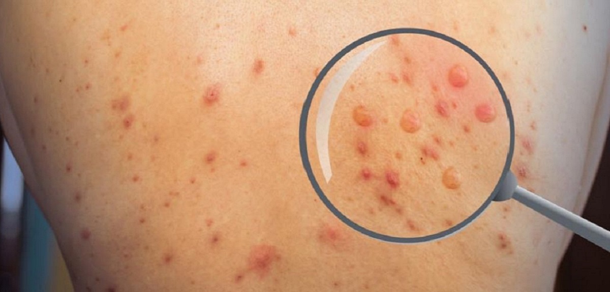 ¿Es una enfermedad sexualmente transmisible? 15 cosas que sabemos sobre el brote de viruela del mono