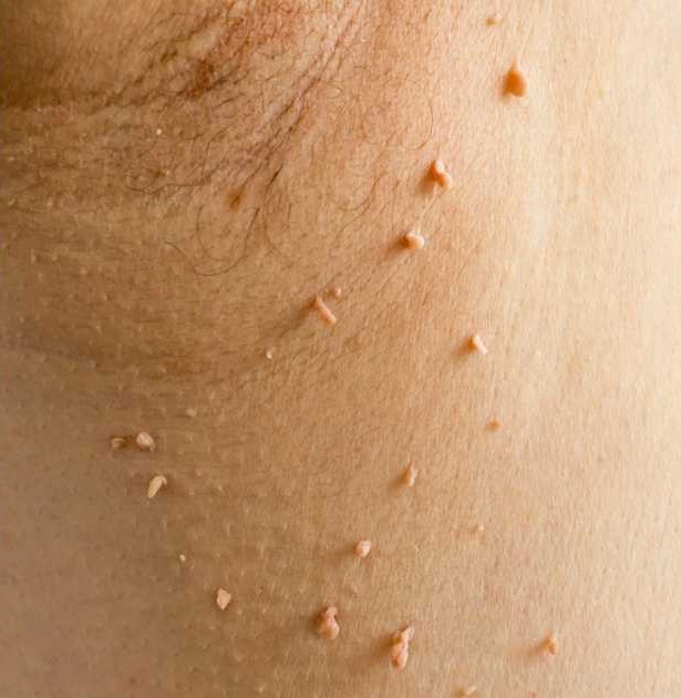 Acrocordones: la afección que aquejó a Lisandra Silva en el embarazo y su tratamiento 