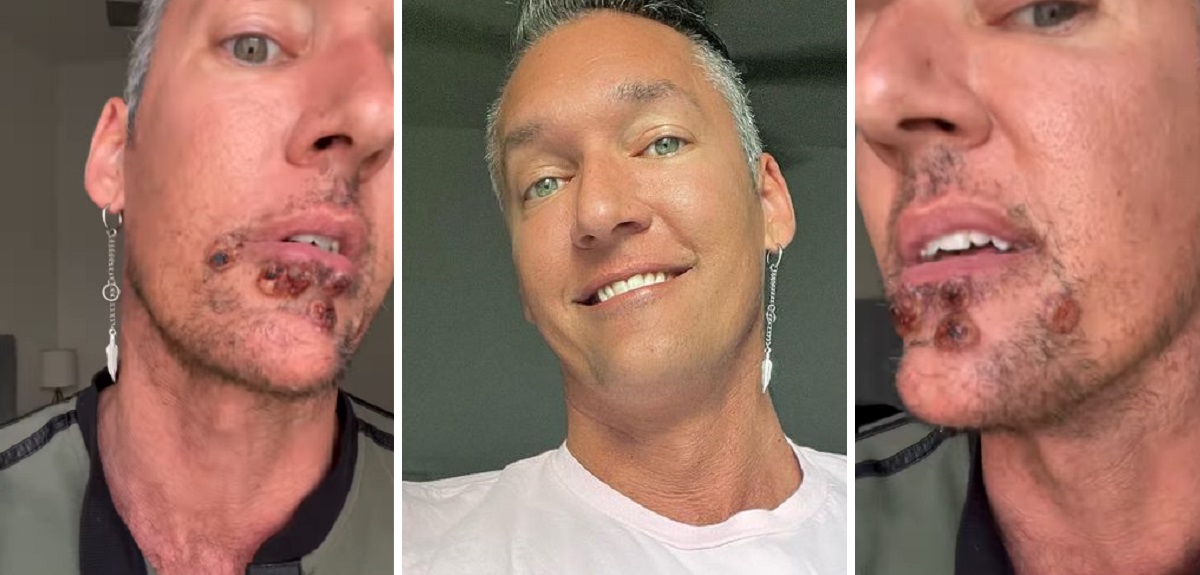 Actor porno contagiado con viruela del mono contó el calvario que vive: 