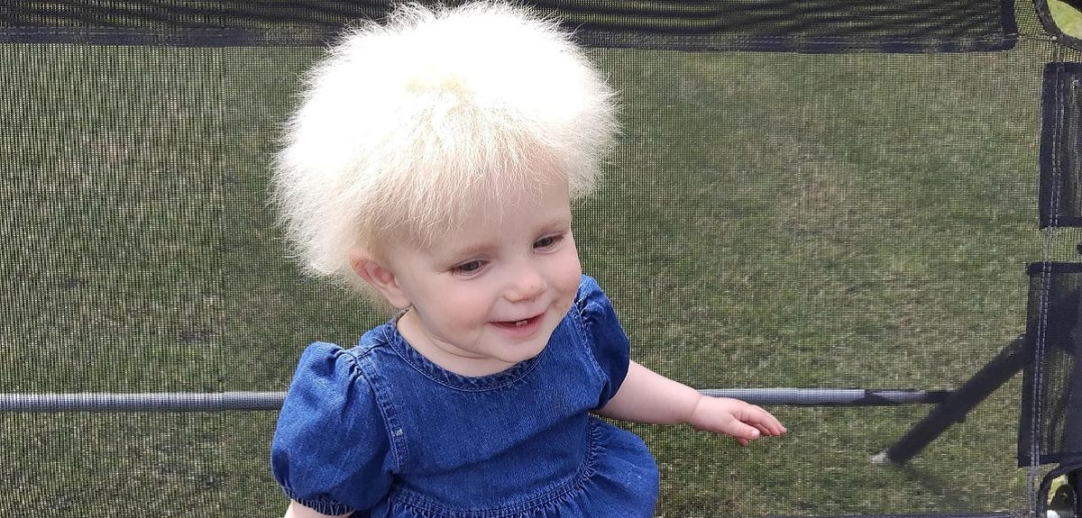 Bebé de 17 meses tiene el raro síndrome de cabello impeinable: solo hay 100 casos en el mundo