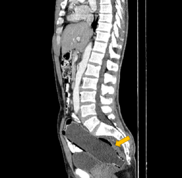 Hombre terminó en urgencias con botella de 19 centímetros en el ano: tardó 3 días en ir a urgencias