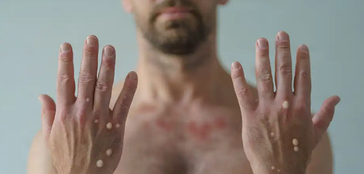 Increíble caso: italiano de 36 años dio positivo al COVID, VIH y viruela del mono al mismo tiempo